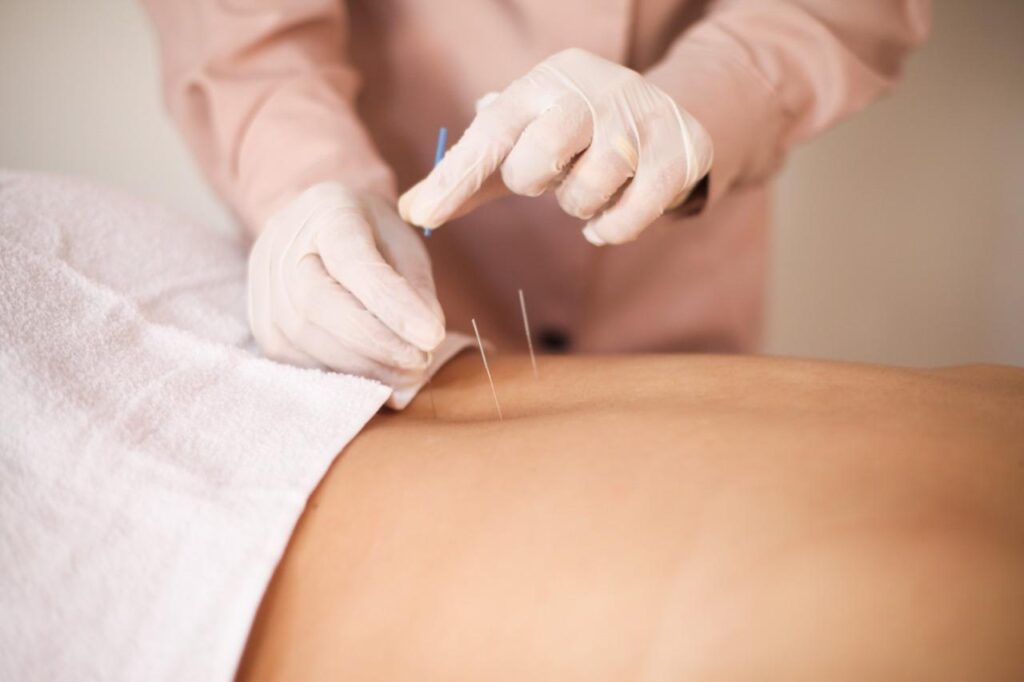 Acupuntura
